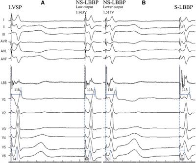 Guidance on left bundle branch pacing using continuous pacing technique and changes in lead V1 characteristics under real-time monitoring